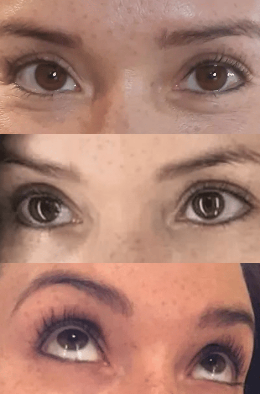 The SofTap Difference