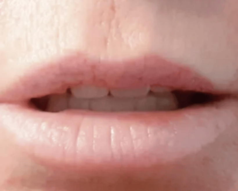 Lips Transformations, photo 7