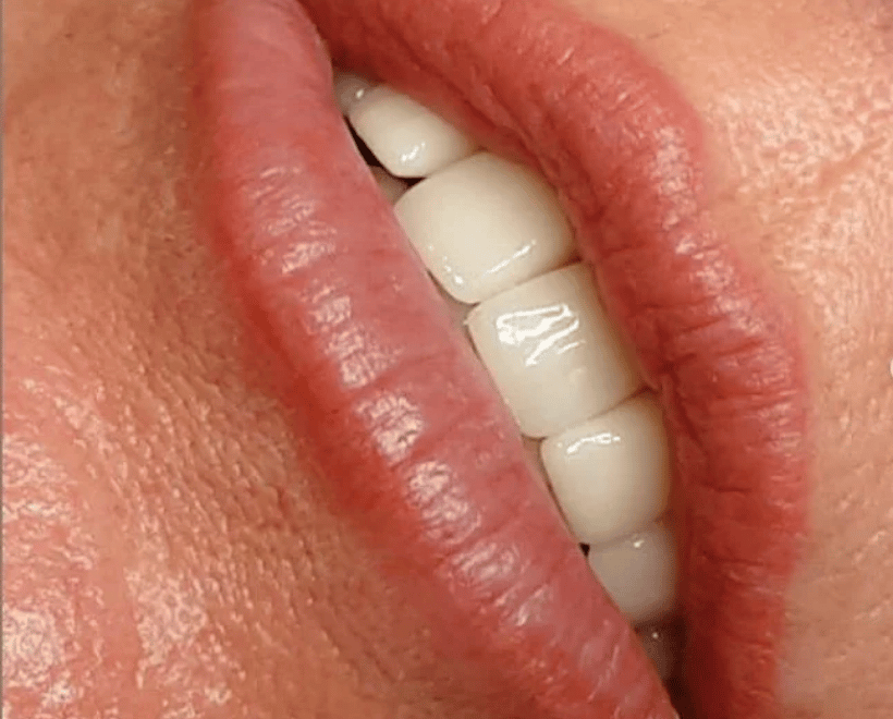 Lips Transformations, photo 8