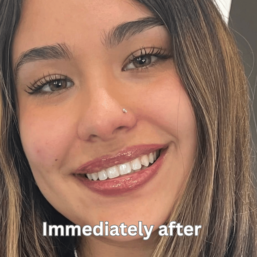 Immediately after
