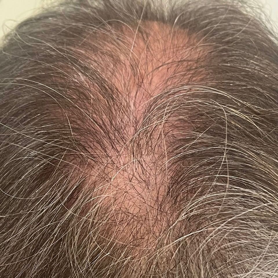 SMP density treatment, before & after