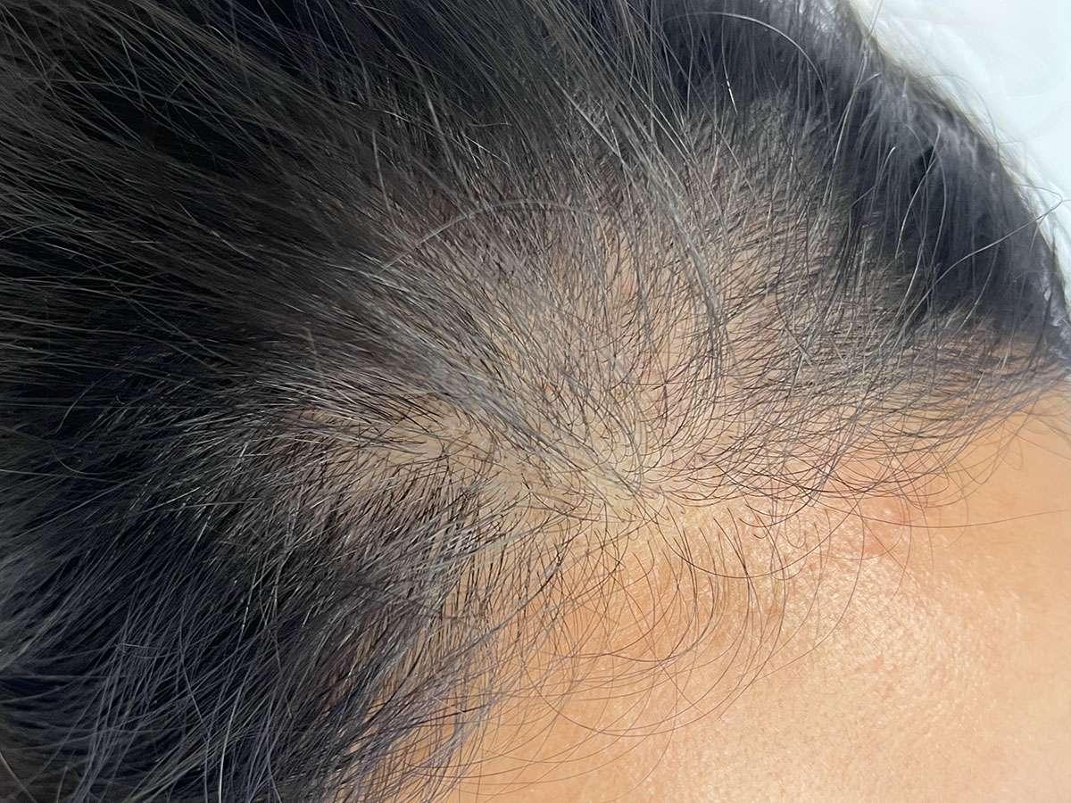 Hide Bald and Thinning Hair with SMP, photo 1