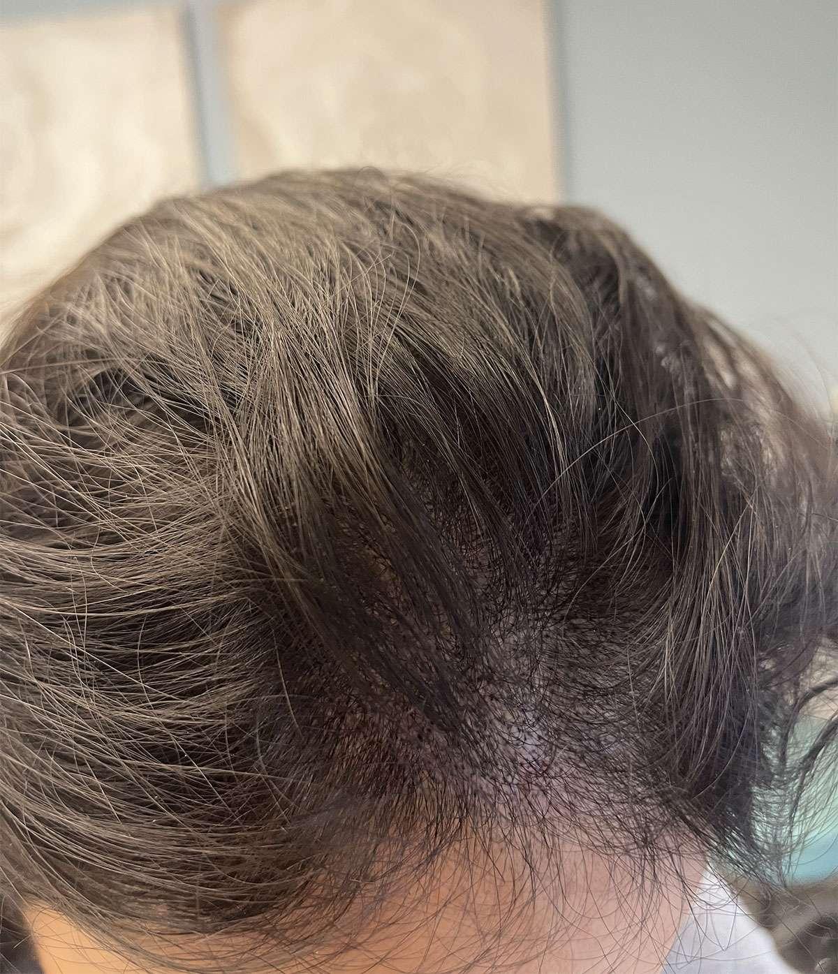 Hide Bald and Thinning Hair with SMP, photo 2