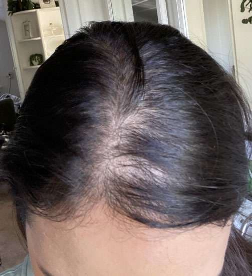 Hide Bald and Thinning Hair with SMP, photo 3