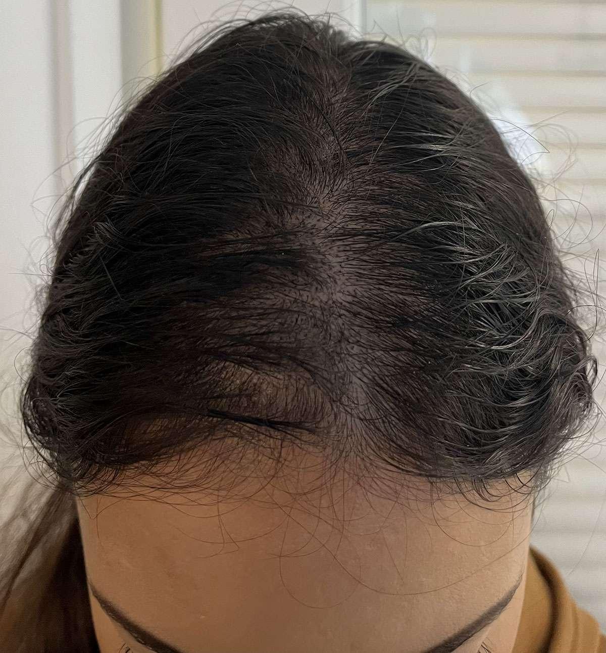 Hide Bald and Thinning Hair with SMP, photo 4