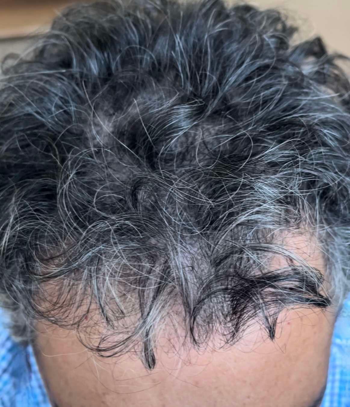 Number One Hairline Replacement Service In the San Francisco Bay Area & Willow Glen Area!, photo 1