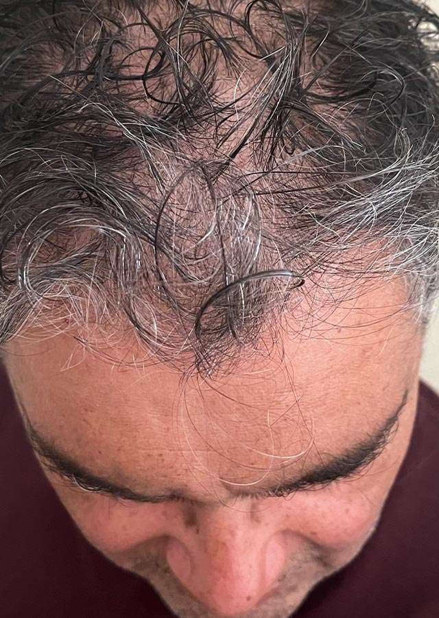 Number One Hairline Replacement Service In the San Francisco Bay Area & Willow Glen Area!, photo 2