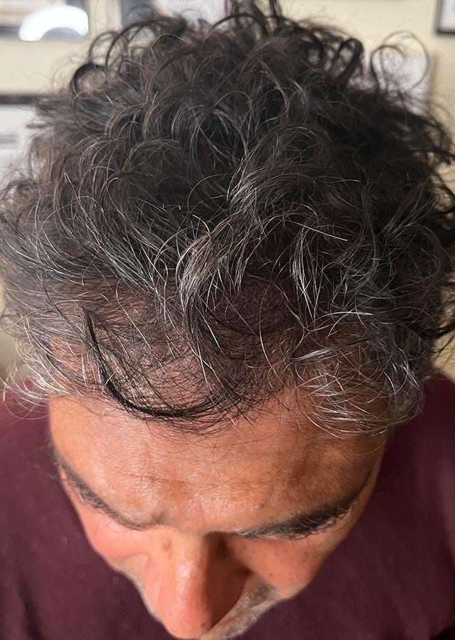 Number One Hairline Replacement Service In the San Francisco Bay Area & Willow Glen Area!, photo 3