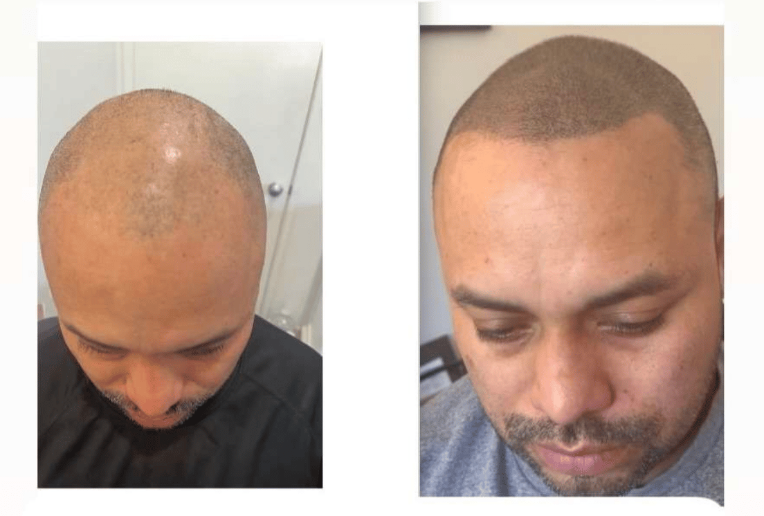 What Is Scalp Micropigmentation? A Complete Beginner’s Guide, photo 1