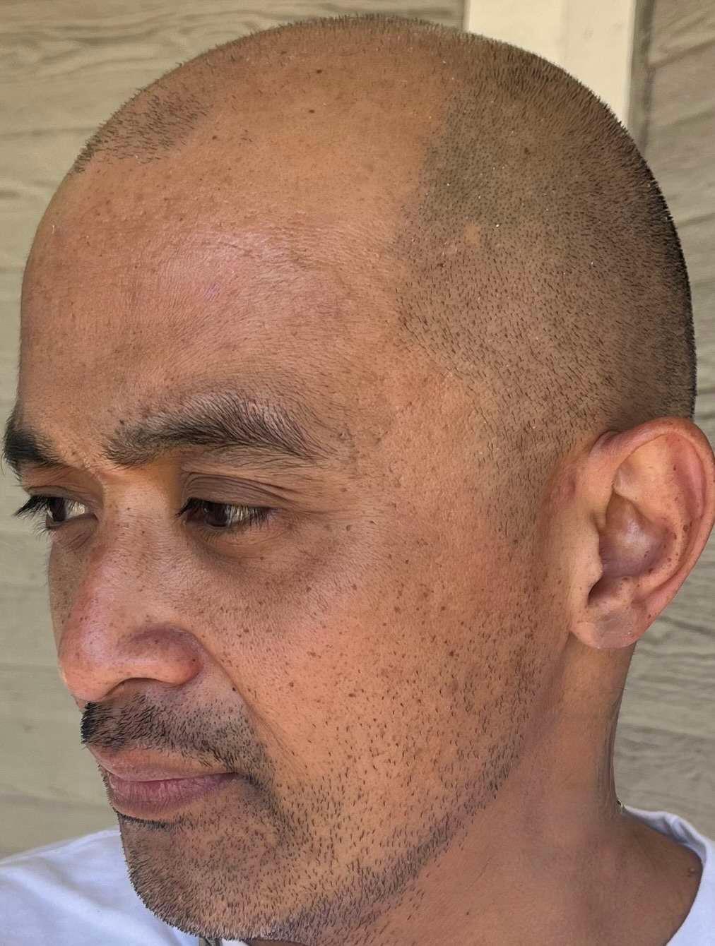 scalp tattoo