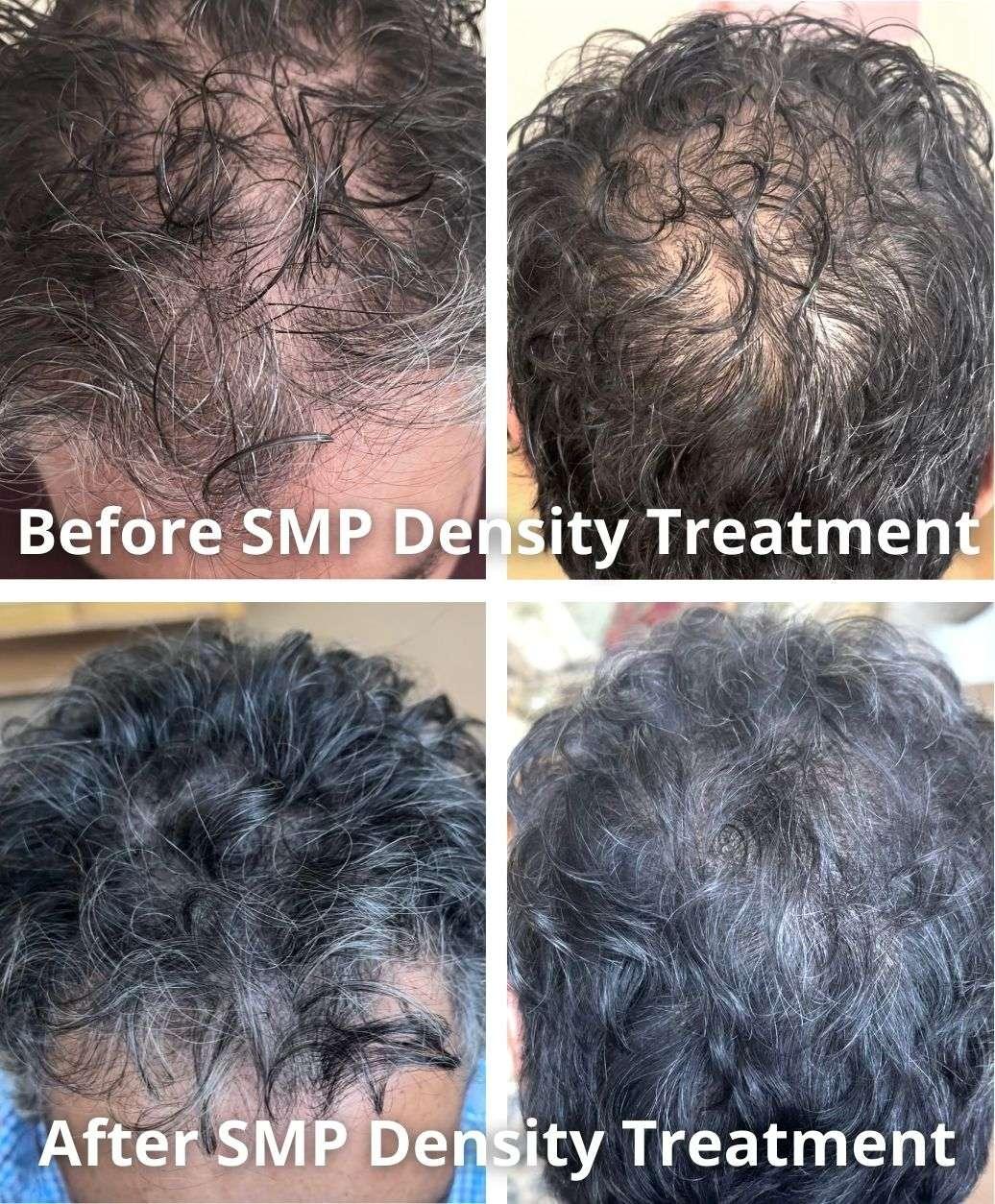 The History and Evolution of SMP: From Concept to Modern Treatment, photo 1