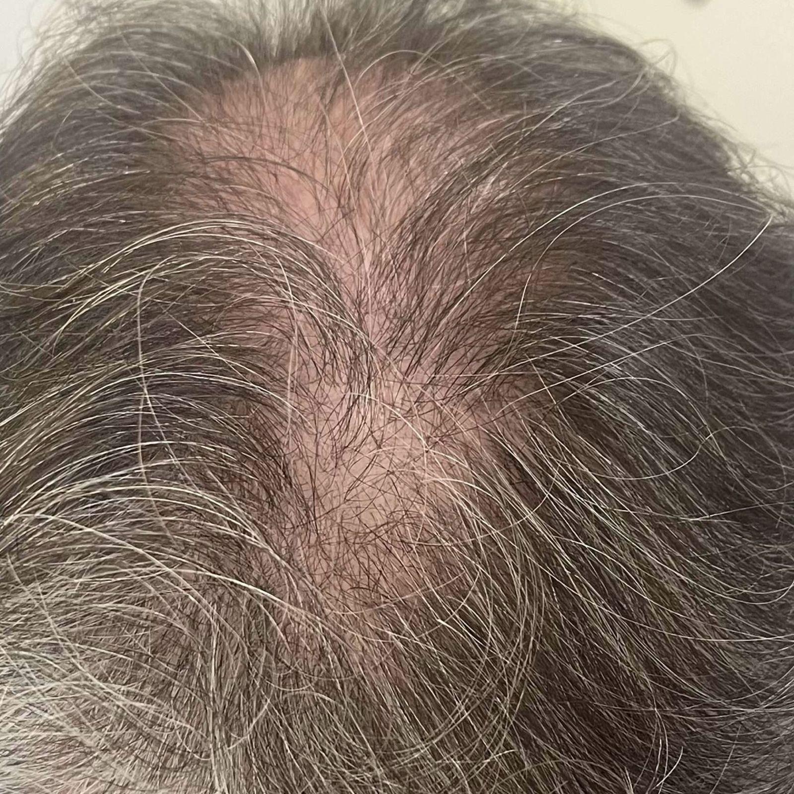 Scalp Micropigmentation