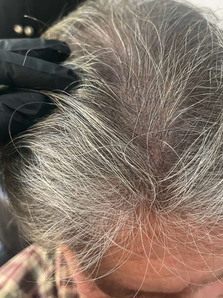 Scalp Micropigmentation