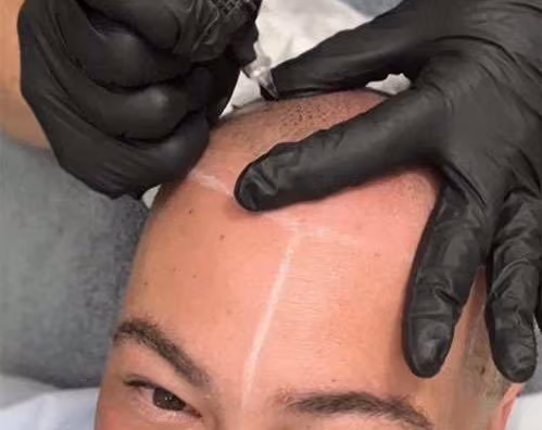 Gloved hands tattooing the hairline of a man's shaved head, with white guide lines marked on his scalp