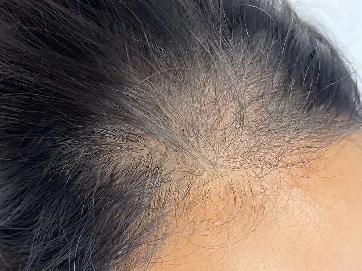 Close-up of thinning dark hair with gray strands and visible scalp at the front hairline