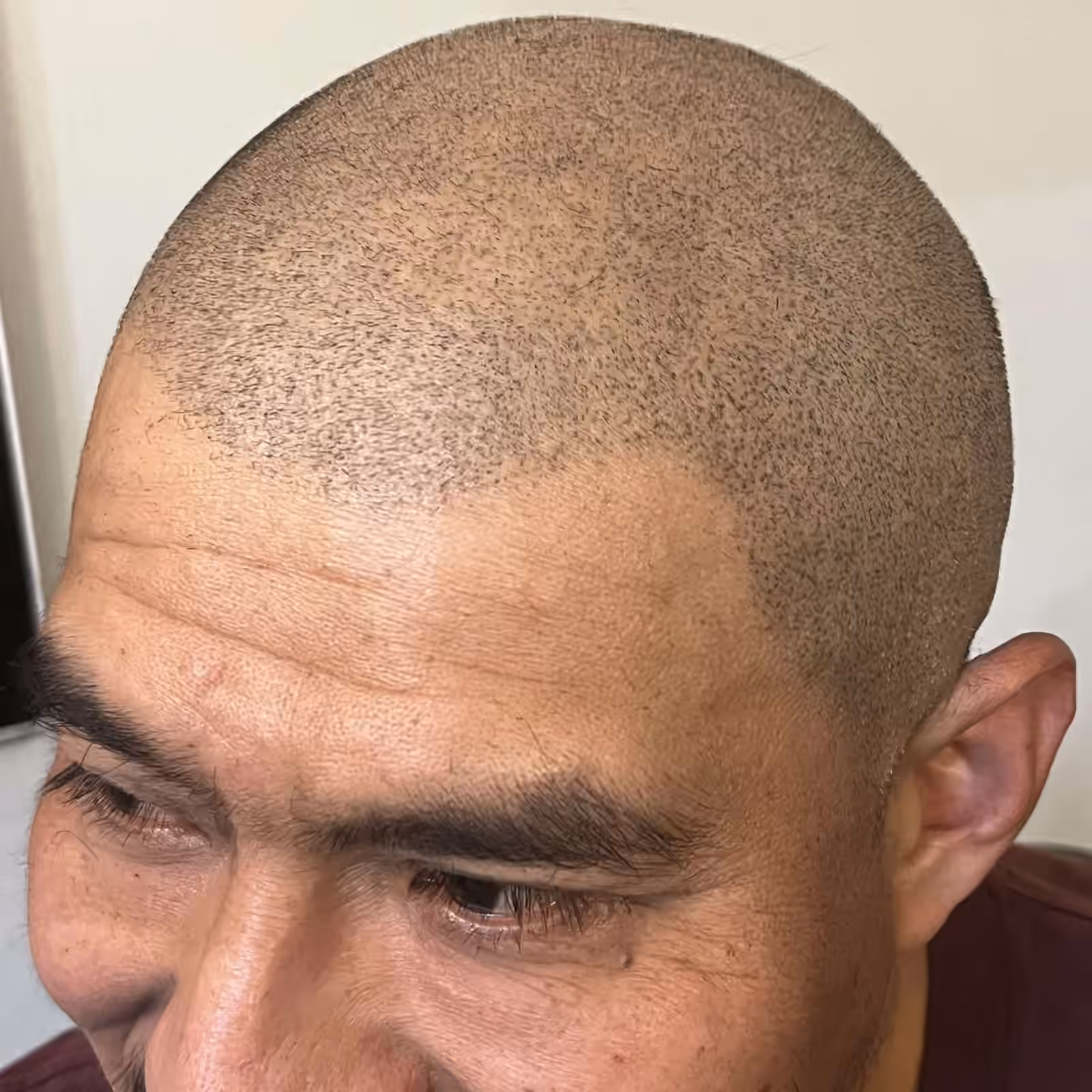 Close-up of a man's closely shaved head showing dense dotted pigment across the scalp and hairline