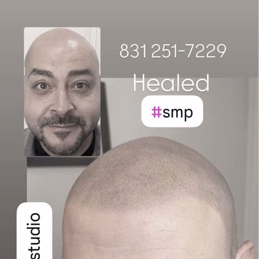 Close-up of a healed shaved scalp with fine SMP dots and a small inset portrait of a bald man with a goatee