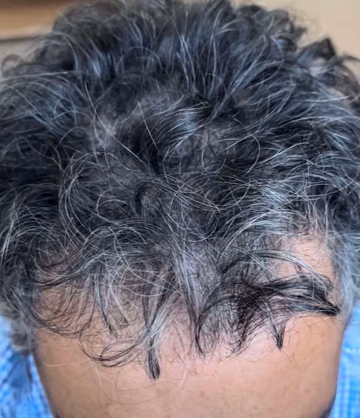 Top-down view of a man's curly dark hair with grey strands and a thinning area at the front hairline