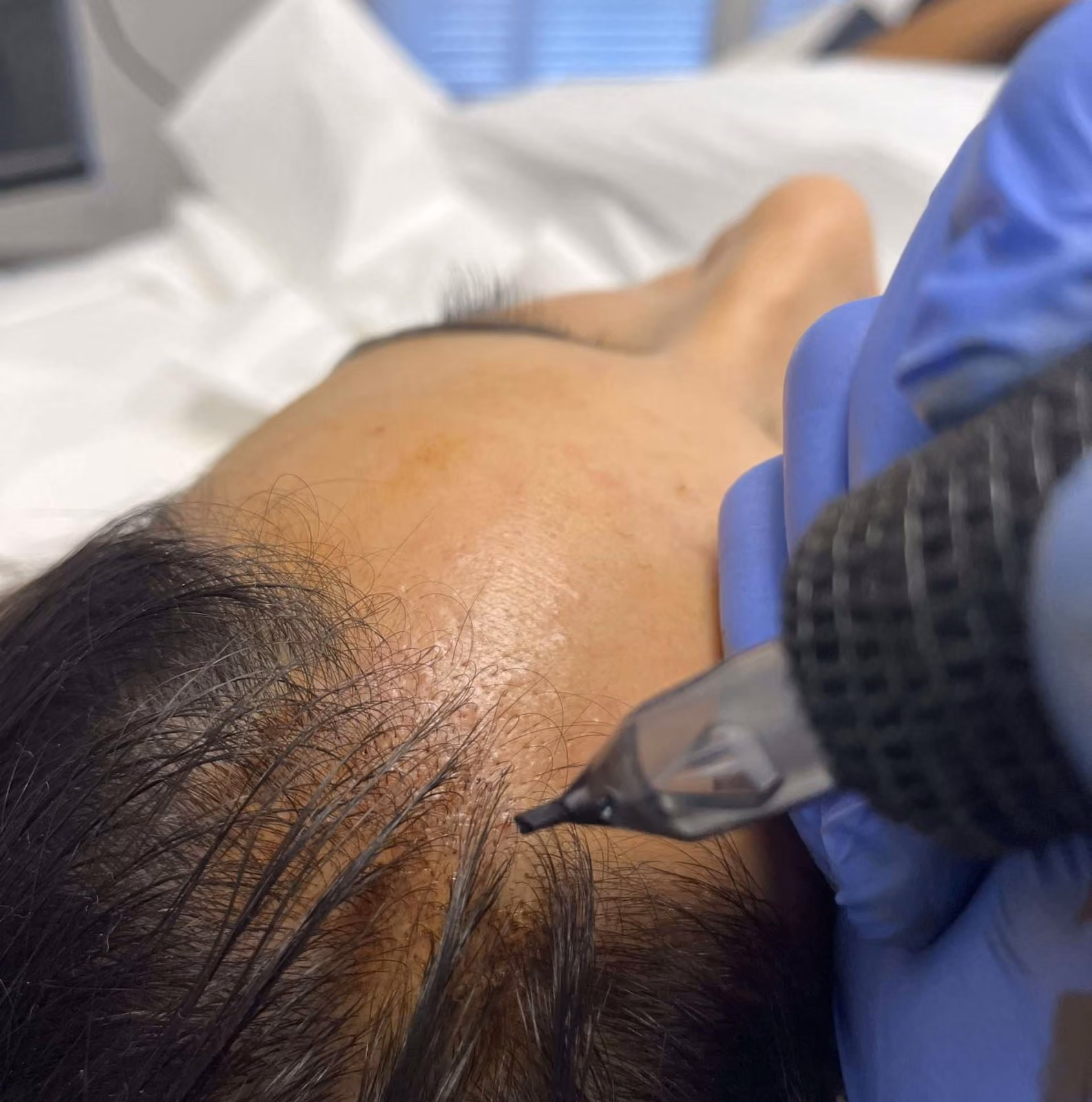 Gloved hand holds a pigment pen against a person's forehead hairline as they lie on a white treatment bed