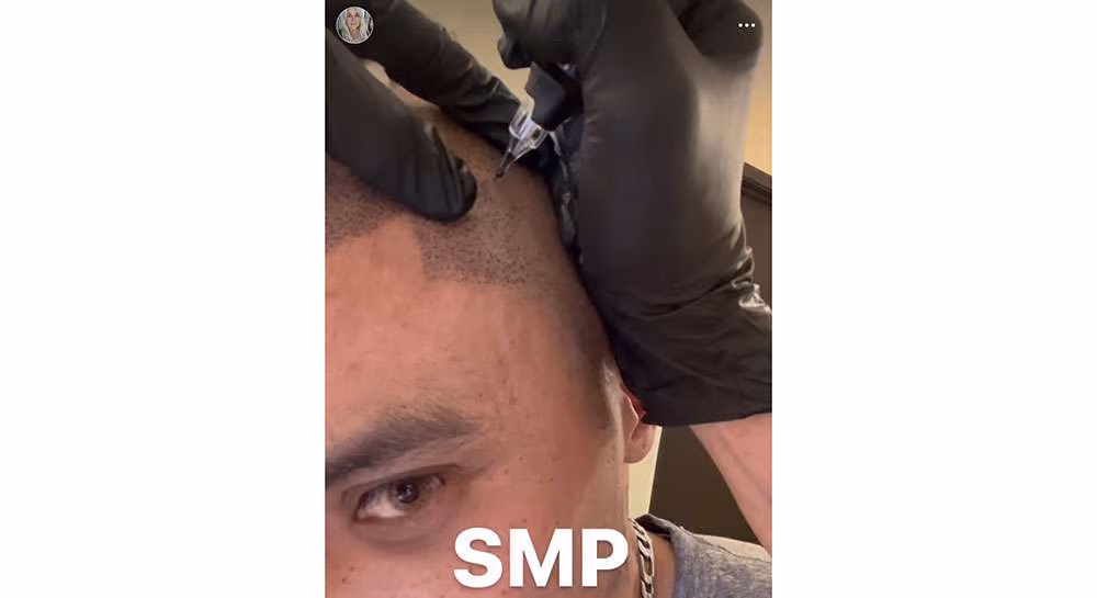 Black-gloved hands hold an SMP pen against a man's scalp at the temple, with a dotted hairline and the word SMP