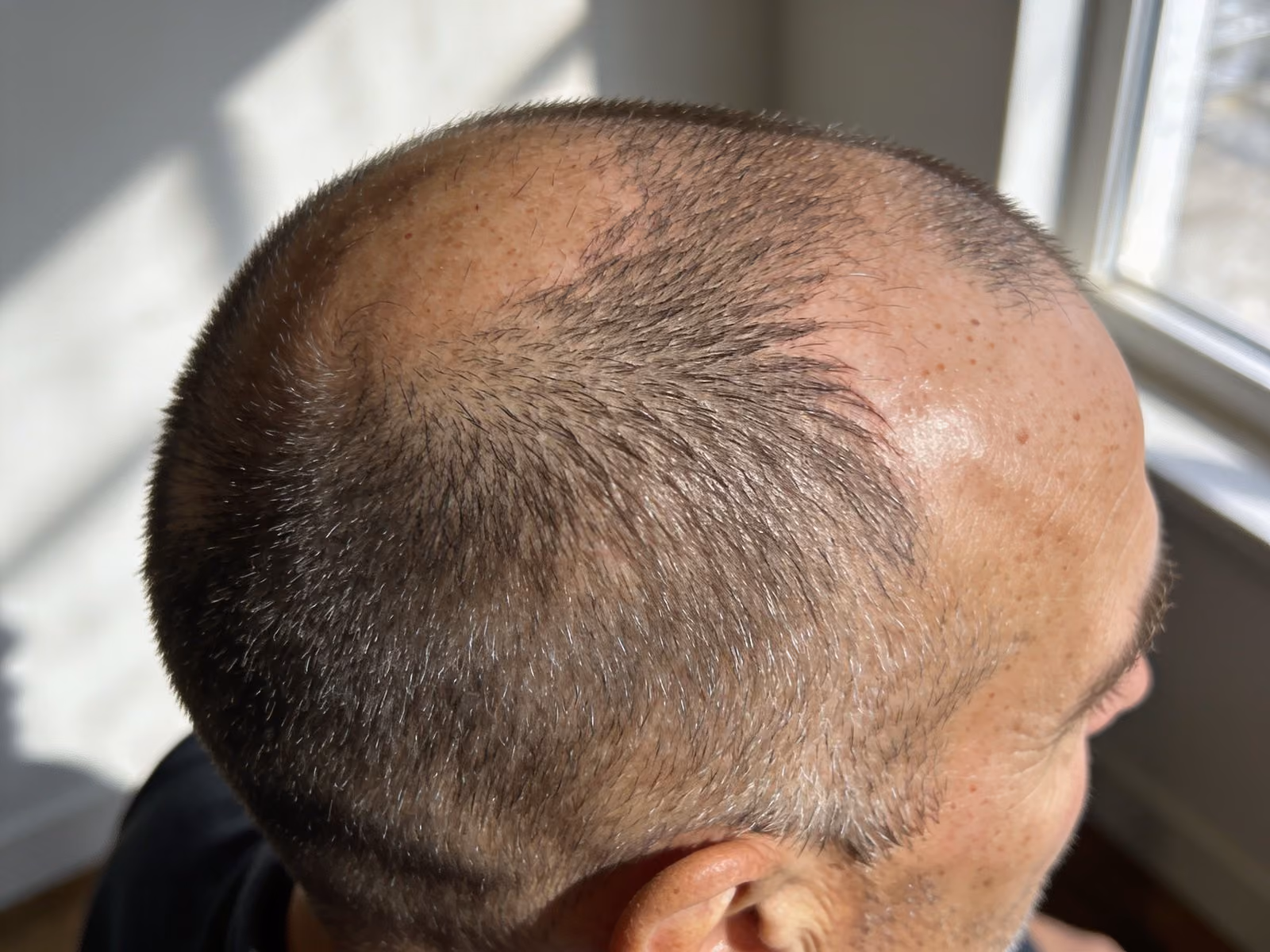 Top view of a man's short cropped head in sunlight with thin patches and gray hairs
