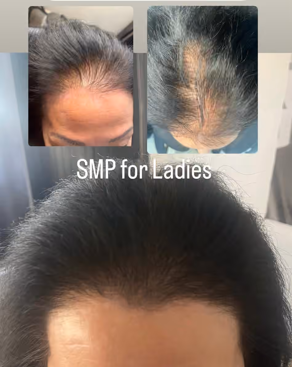 Collage titled SMP for Ladies with three close views of a woman's hairline and thinning crown
